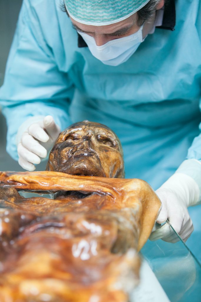 Der Mumienexperte Albert Zink untersucht und berührt in Schutzkleidung den Kopf von Ötzi der Gletschermumie im Labor